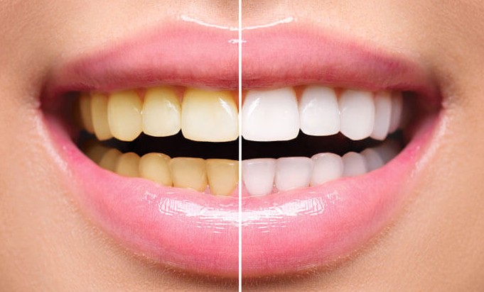 10 Möglichkeiten, wie das Bleichen der Zähne Ihrem Leben