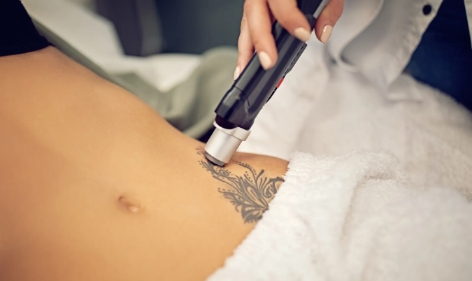 10 Tipps, wie Sie Ihr Tattoo durch Laserbehandlung entfernen lassen